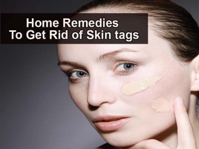 Home remedies to remove skin tags